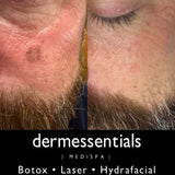 LIVE DEMO : Laser Spot Removal