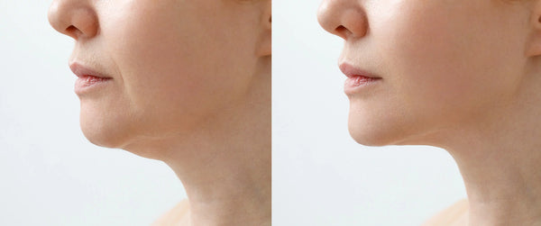 Laser Chin Sculpting