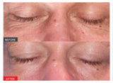 Buy 2, get 1 FREE : Smooth Laser Eye Tightening