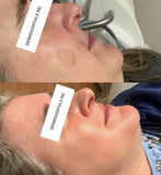 LIVE DEMO: Hyperpigmentation Starwalker Total Rejuvenation Laser