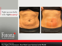 Fotona Abdomen Sculpting : 20% off 1 or buy 3, get 1 FREE