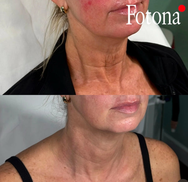 Fotona Neck Sculpting