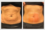 Fotona Abdomen Sculpting : 20% off 1 or buy 3, get 1 FREE