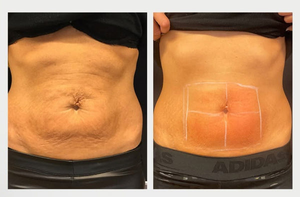 Fotona Abdomen Sculpting : 20% off 1 or buy 3, get 1 FREE