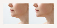 🎄 3 Pack: Hotsculpting Chin 🎄