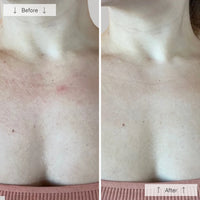 Omnilux Contour Neck & Décolleté