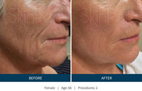 MicroNeedling • Anti Wrinkle | Pore Shrinking