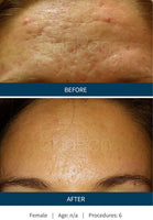 MicroNeedling • Anti Wrinkle | Pore Shrinking