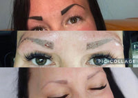Laser Brow Tattoo Removal