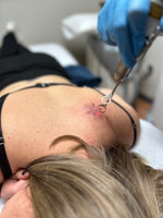 LIVE DEMO : Laser Tattoo Removal March 18th 5:10PM