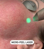 LIVE DEMO : Resurfacing Laser MicroPeel March 12th