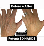 LIVE DEMO: Hyperpigmentation Starwalker Total Rejuvenation Laser