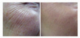 Fractional Laser Resurfacing