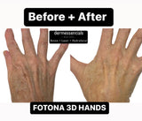 LIVE DEMO: Hyperpigmentation Starwalker Total Rejuvenation Laser