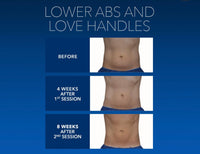 LIVE DEMO of Coolsculpting March 18th 4 PM