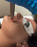 Fractional Laser Resurfacing